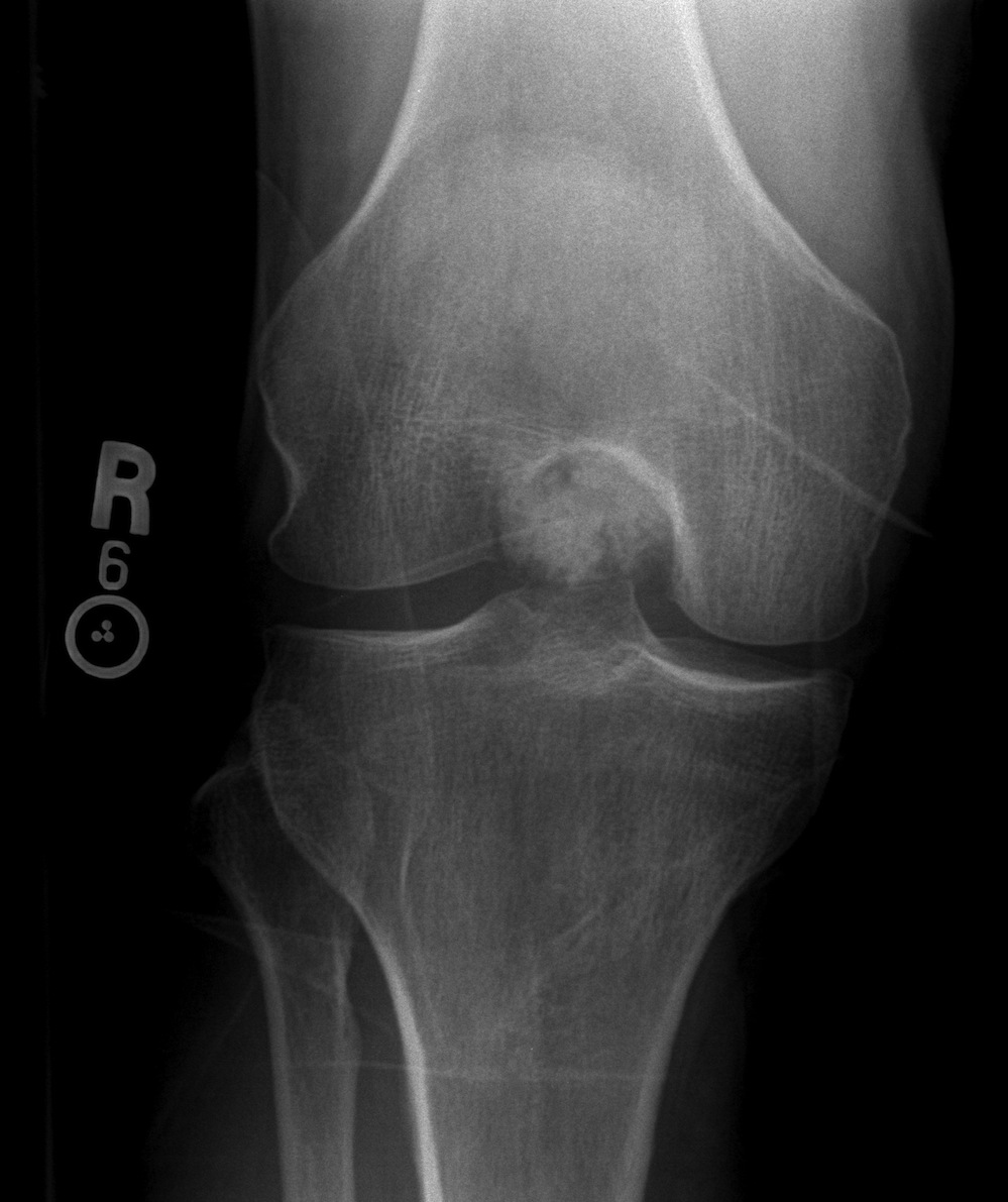Figure 2 for case Parosteal osteoma ( RID4002 )